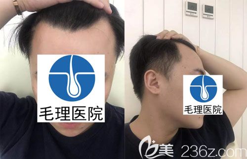 韓國毛理醫(yī)院發(fā)際線種植+鬢角種植真人案例 韓國毛理醫(yī)院發(fā)際線種植+鬢角種植真人案例