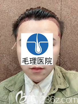 韓國種植發(fā)際線+鬢角移植手術(shù)當天 韓國種植發(fā)際線+鬢角移植手術(shù)當天