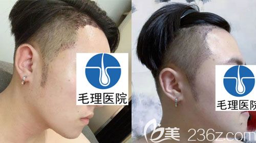 對比國內(nèi)與韓國植發(fā)價格后選韓國毛理醫(yī)院做鬢角植發(fā)+種植發(fā)際線圖片反饋