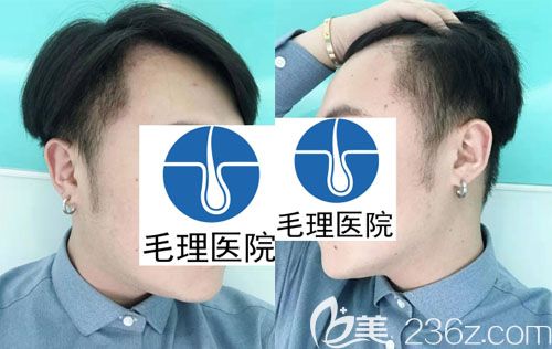 韓國種植發(fā)際線圖片術(shù)后1月恢復(fù)圖 韓國種植發(fā)際線圖片術(shù)后1月恢復(fù)圖
