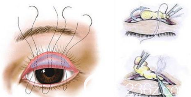 雙眼皮手術(shù) 雙眼皮手術(shù)