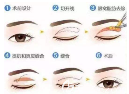 全切雙眼皮手術(shù)流程 全切雙眼皮手術(shù)流程