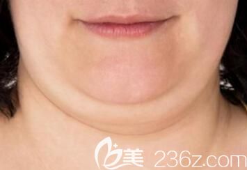 面部脂肪堆積過多導(dǎo)致出現(xiàn)臉大雙下巴形成