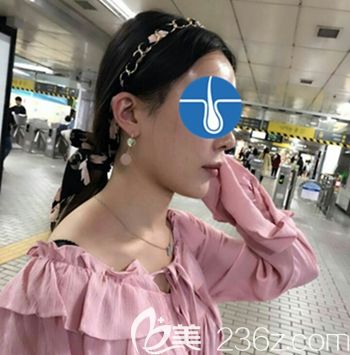 在韓國毛理做發(fā)際線移植術后2天 在韓國毛理做發(fā)際線移植術后2天