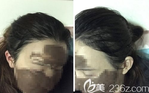 天生發(fā)際線稀少的我找韓國毛理醫(yī)院做了發(fā)際線移植后8個月的恢復(fù)情況