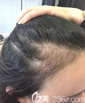 在韓國毛理做發(fā)際線移植術后1個月 在韓國毛理做發(fā)際線移植術后1個月