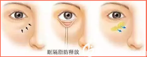 眶隔釋放法去眼袋手術過程