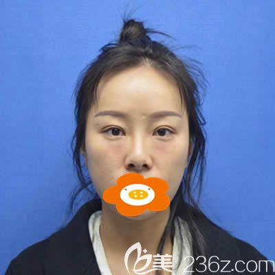 我在福州美貝爾找楊國化做完肋軟骨隆鼻術(shù)前照 我在福州美貝爾找楊國化做完肋軟骨隆鼻術(shù)前照