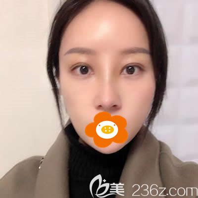 福州美貝爾楊國化為我做肋軟骨隆鼻術(shù)后半個月美圖 福州美貝爾楊國化為我做肋軟骨隆鼻術(shù)后半個月美圖