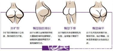 自體脂肪豐臀價格貴嗎？