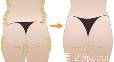 自體脂肪豐臀能夠維持多久呢？