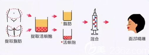 自體脂肪填充面部手術(shù)過(guò)程圖
