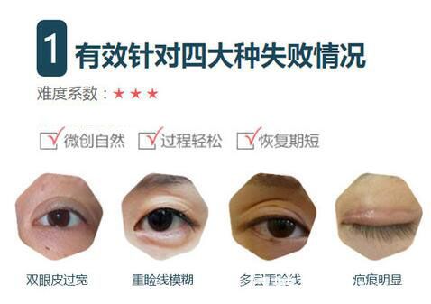 哪些眼睛需要做雙眼皮修復(fù)