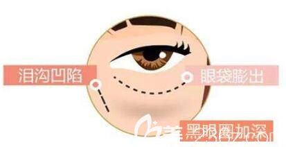 玻尿酸去黑眼圈效果怎么樣？