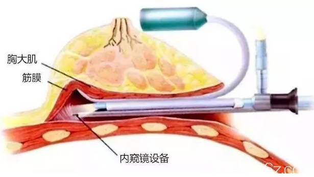 假體隆胸手術(shù)圖解