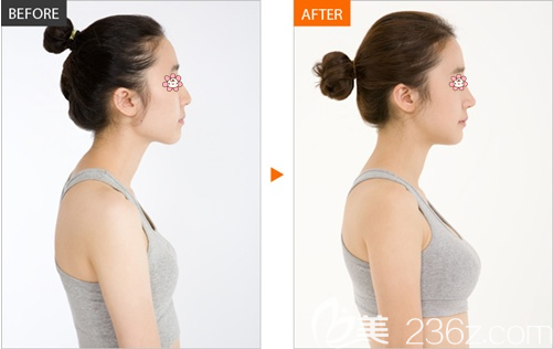 假體隆胸術(shù)前術(shù)后效果對比