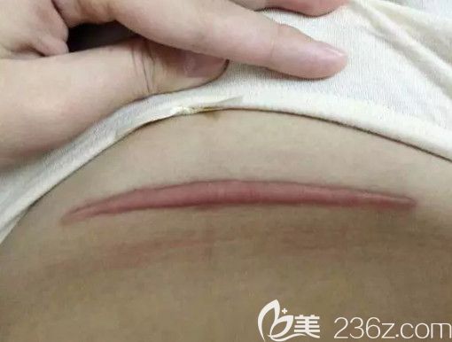 剖腹產(chǎn)疤痕增生的樣子