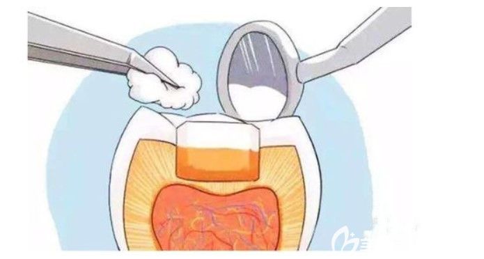 天津愛齒口腔袁新明醫(yī)生告訴你牙齒壞了怎么辦 天津愛齒口腔袁新明醫(yī)生告訴你牙齒壞了怎么辦