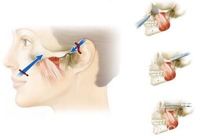 磨骨瘦臉有危險嗎？