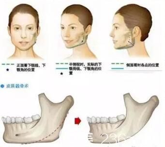 磨骨瘦臉后遺癥