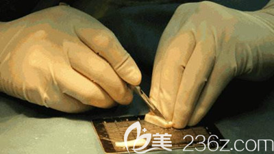 肋軟骨隆鼻的優(yōu)勢