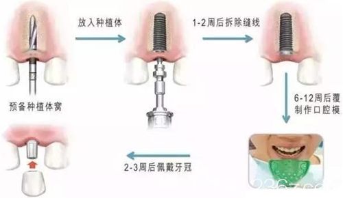 種植牙的種植修復(fù)過程圖 種植牙的種植修復(fù)過程圖