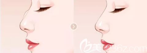 肋軟骨自愈能力強(qiáng)