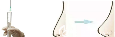 注射隆鼻示意圖