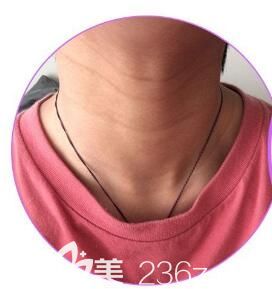 20歲頸紋很明顯 20歲頸紋很明顯