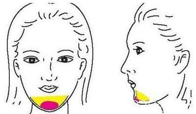 自體脂肪墊下巴