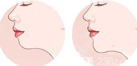 自體脂肪墊下巴原理