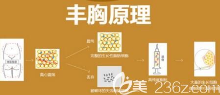 自體脂肪豐胸的原理介紹