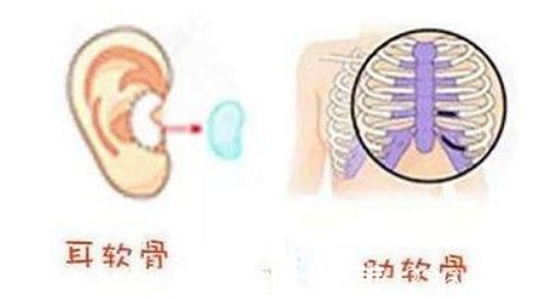 自體軟骨隆鼻的選擇 自體軟骨隆鼻的選擇