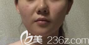 法令紋深重的自己求問(wèn)注射玻尿酸后能保持多久