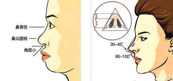 鼻基底凹陷填充術(shù)前術(shù)后示意圖