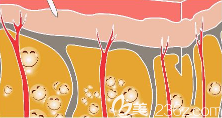 全身吸脂手術(shù)示意圖