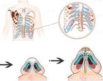 肋軟骨隆鼻效果怎么樣？
