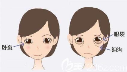 自體脂肪填充臥蠶能夠維持多久呢？