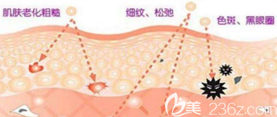 光子嫩膚治療示意圖