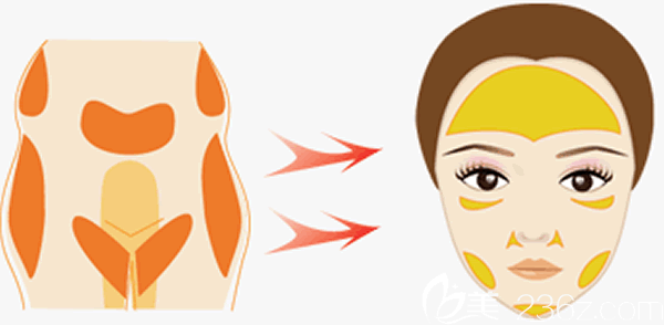 自體脂肪填充面部2個(gè)月穩(wěn)定了嗎的詳細(xì)解答