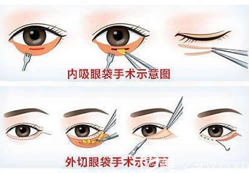 內(nèi)切法、外切法去眼袋圖解