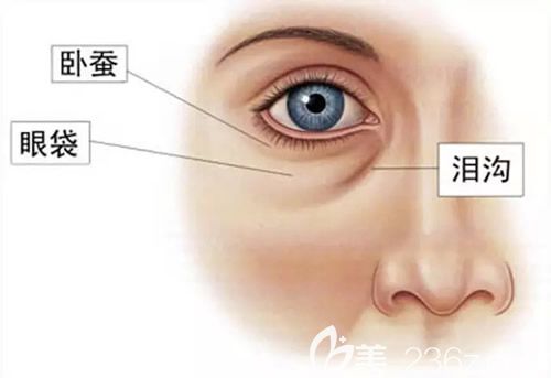 眼袋、臥蠶、淚溝的區(qū)分照片