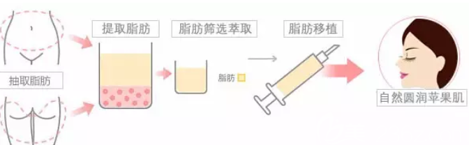 自體脂肪填充蘋果肌手術(shù)過(guò)程圖