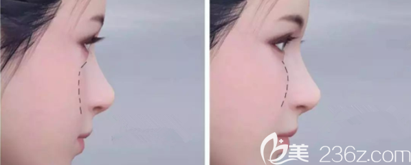 自體脂肪填充蘋果肌效果圖