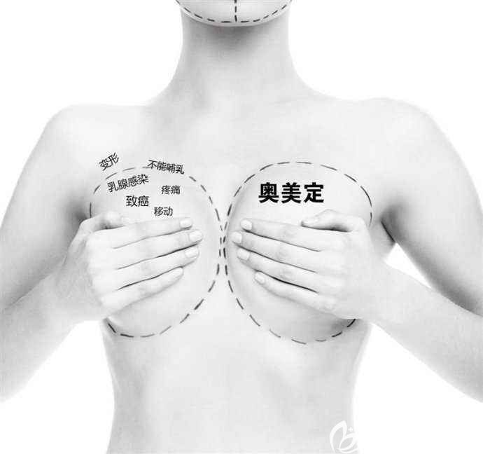 注射隆胸奧美定危害較大 注射隆胸奧美定危害較大