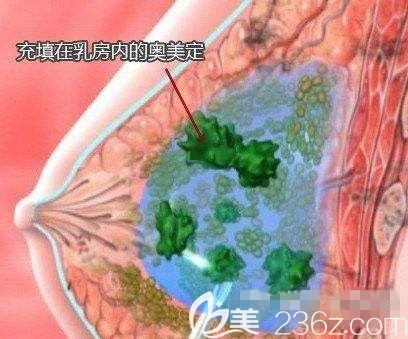 填充在乳房內(nèi)的奧美定出現(xiàn)病變游走 填充在乳房內(nèi)的奧美定出現(xiàn)病變游走