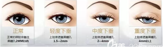 上眼瞼下垂類(lèi)型
