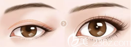 上瞼下垂矯正前后