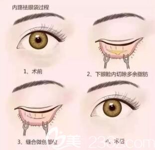內(nèi)切去眼袋