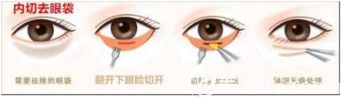 內(nèi)切去眼袋術(shù)后效果怎么樣？